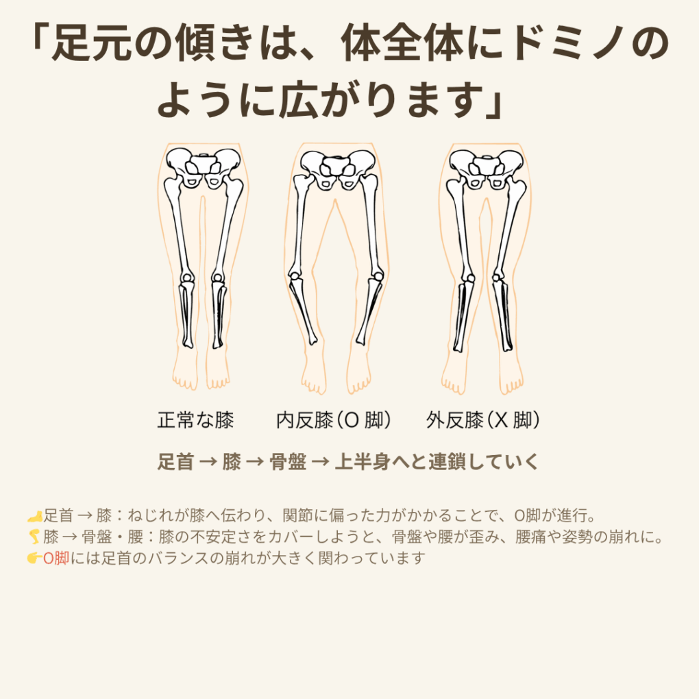 正常膝・内反膝(O脚)・外反膝(X脚)を比較した骨格イラスト。足元の傾きが膝や骨盤に連鎖する様子を示す図。